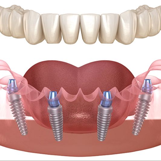 All-on-4 Dental Implants