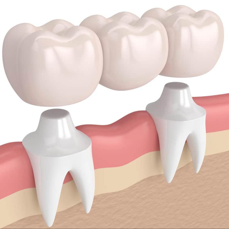 Dental Bridges