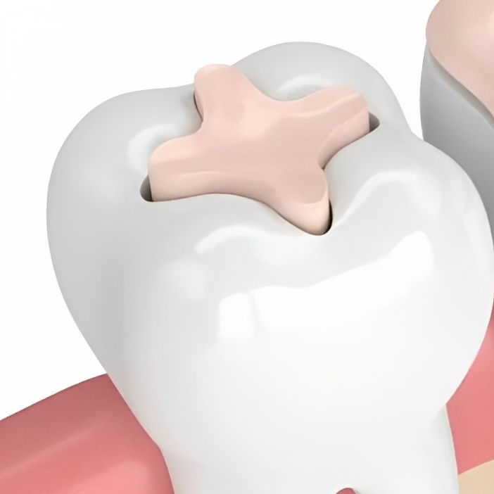 Dental Inlays