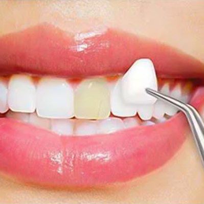 Porcelain Dental Veneers