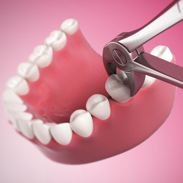 Tooth Extraction